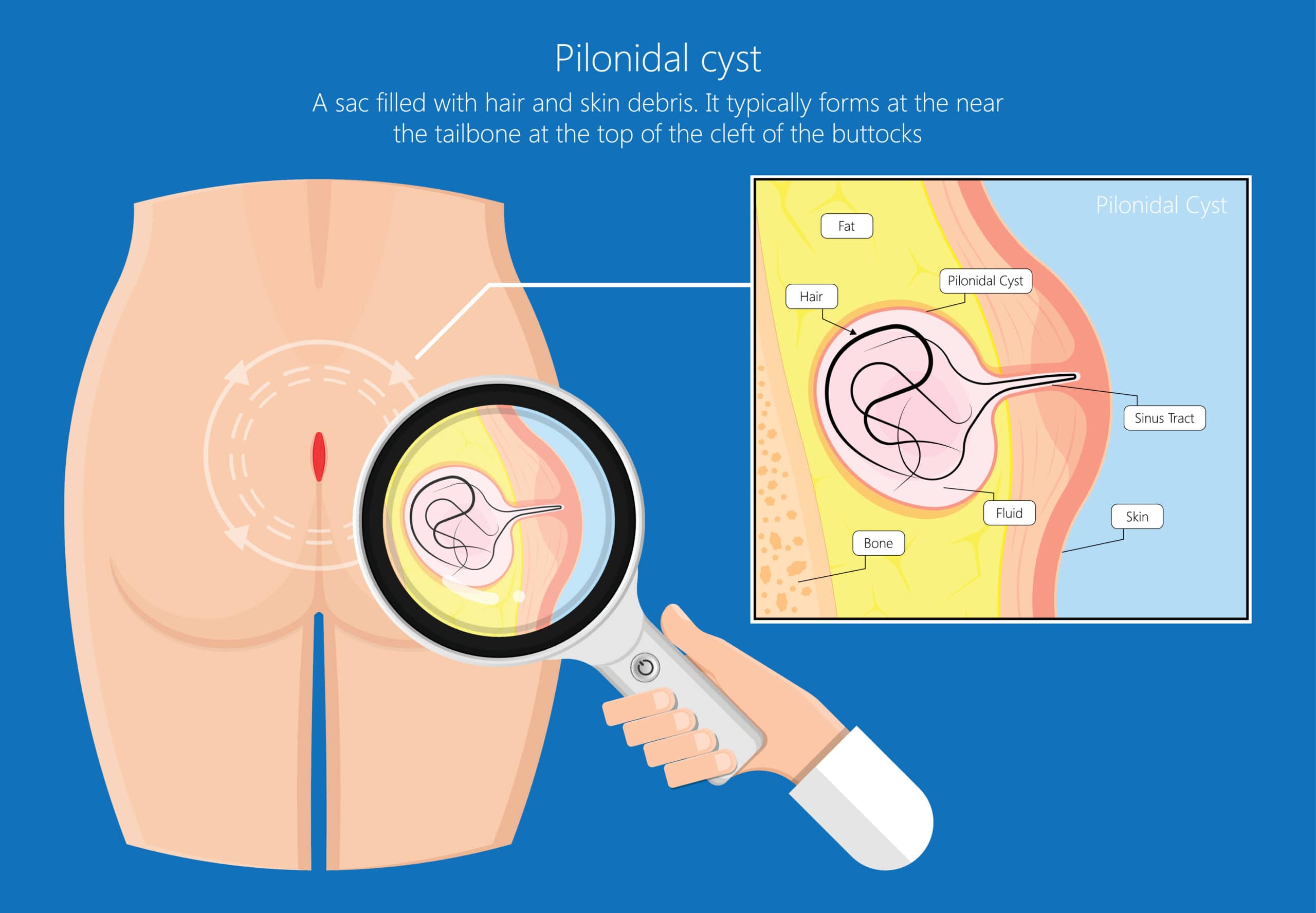 Pilonidal disease