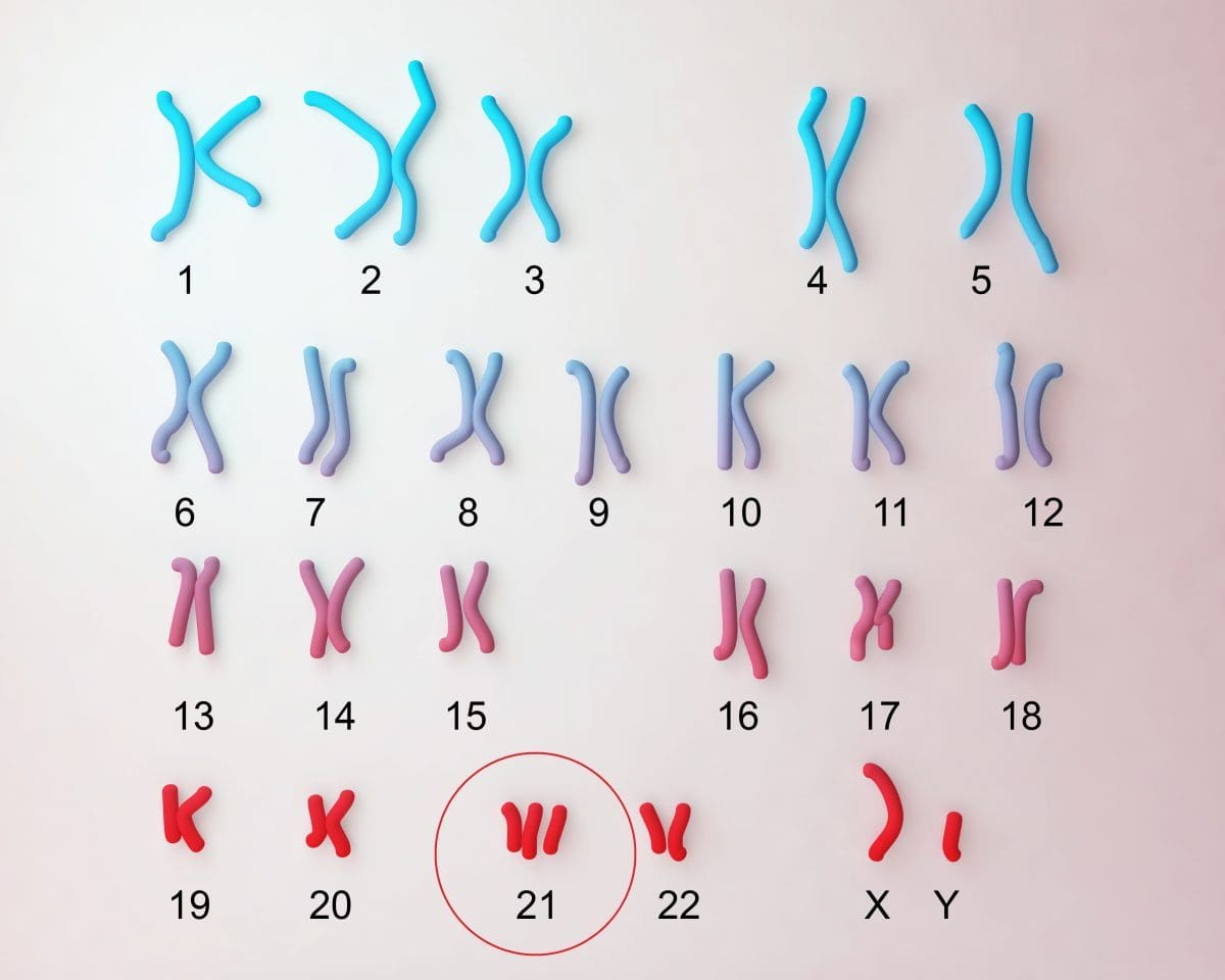 Down syndrome trisomy 21 