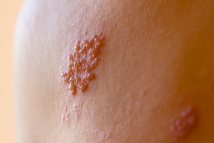 Shingles: essential facts