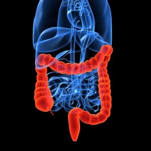 Colorectal cancer does early screening help?