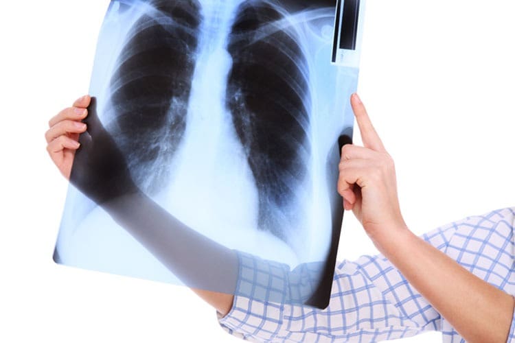 Chronic obstructive pulmonary disease: COPD