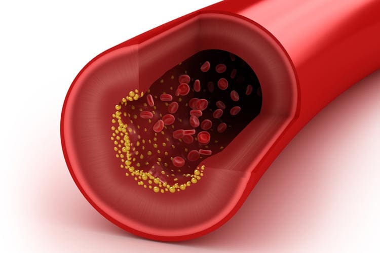 Cholesterol and your arteries