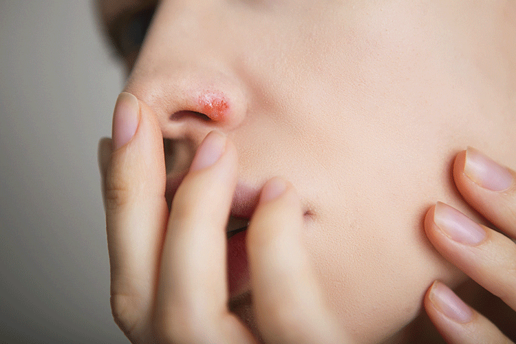 Cold sore infections