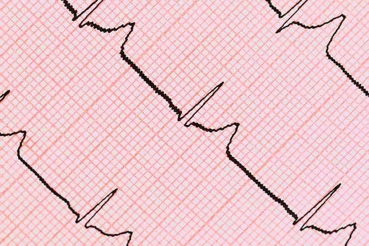 Electrocardiogram – ECG