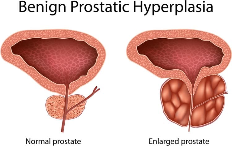 prostate enlargement