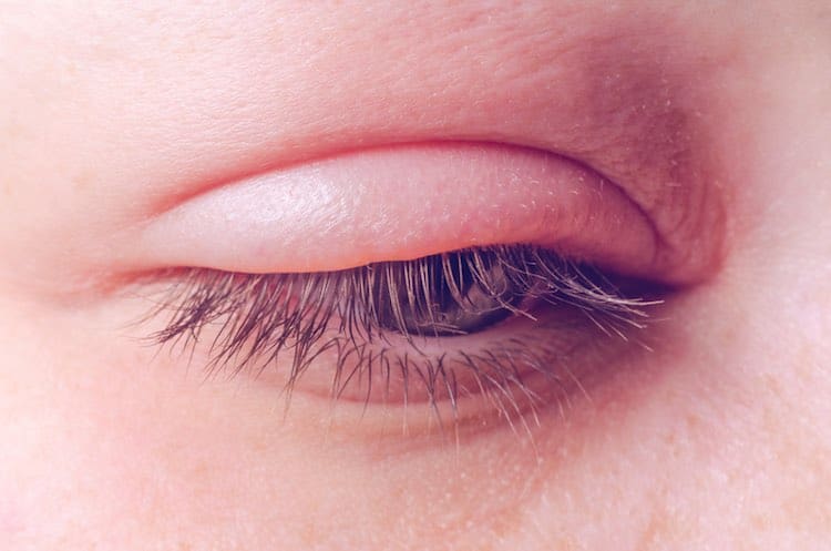 Eyelid and eyelash problems