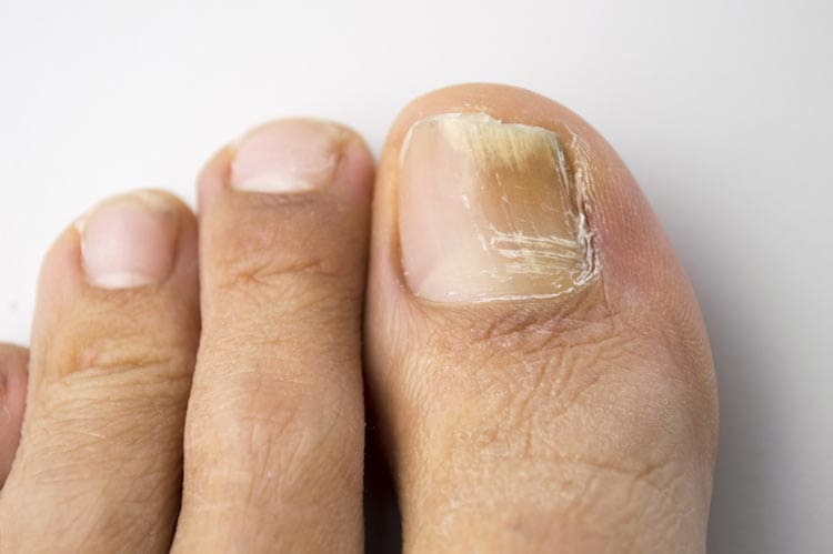 Fungal nail problems