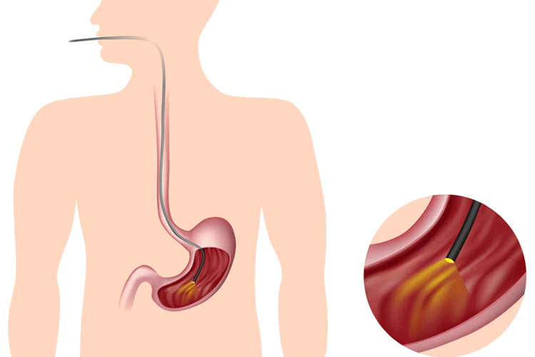 Gastroscopy: examination of the upper digestive tract