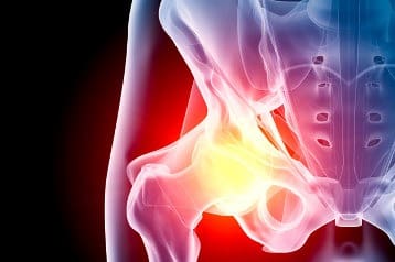 Arthritis and surgery: hip replacement