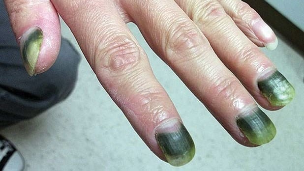 A case of green nail syndrome