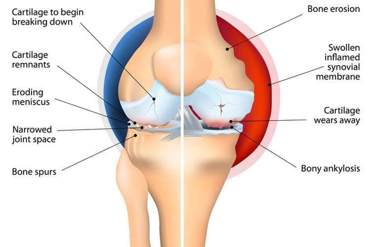 Arthritis: how osteoarthritis and rheumatoid arthritis affect joints