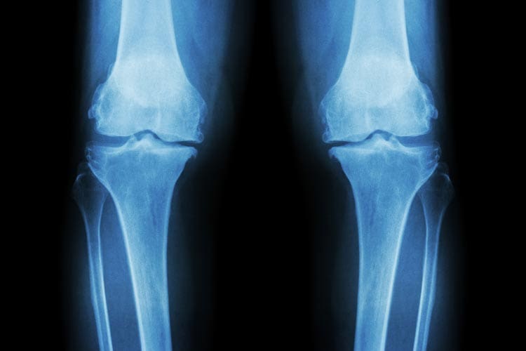Osteoarthritis: what it does to your joints