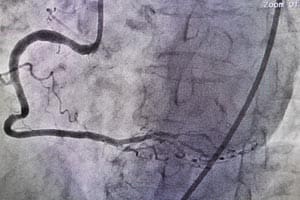 Coronary angiography