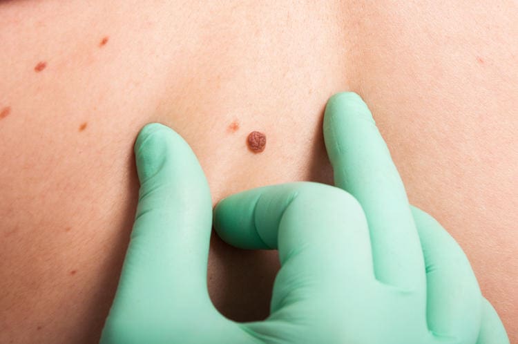 Skin cancer types and treatments explained