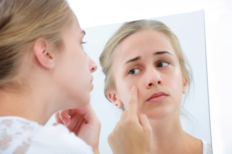Acne treatments