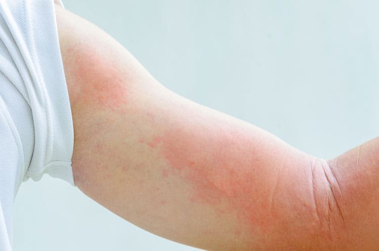Allergy testing a waste of time in hives (urticaria)