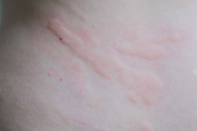 Urticaria (hives): self-care