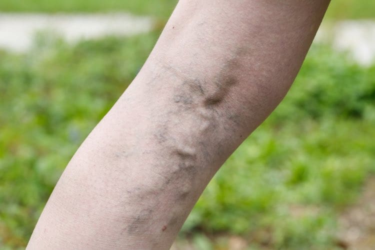 Varicose veins and support stockings