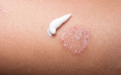 Fungal skin infections