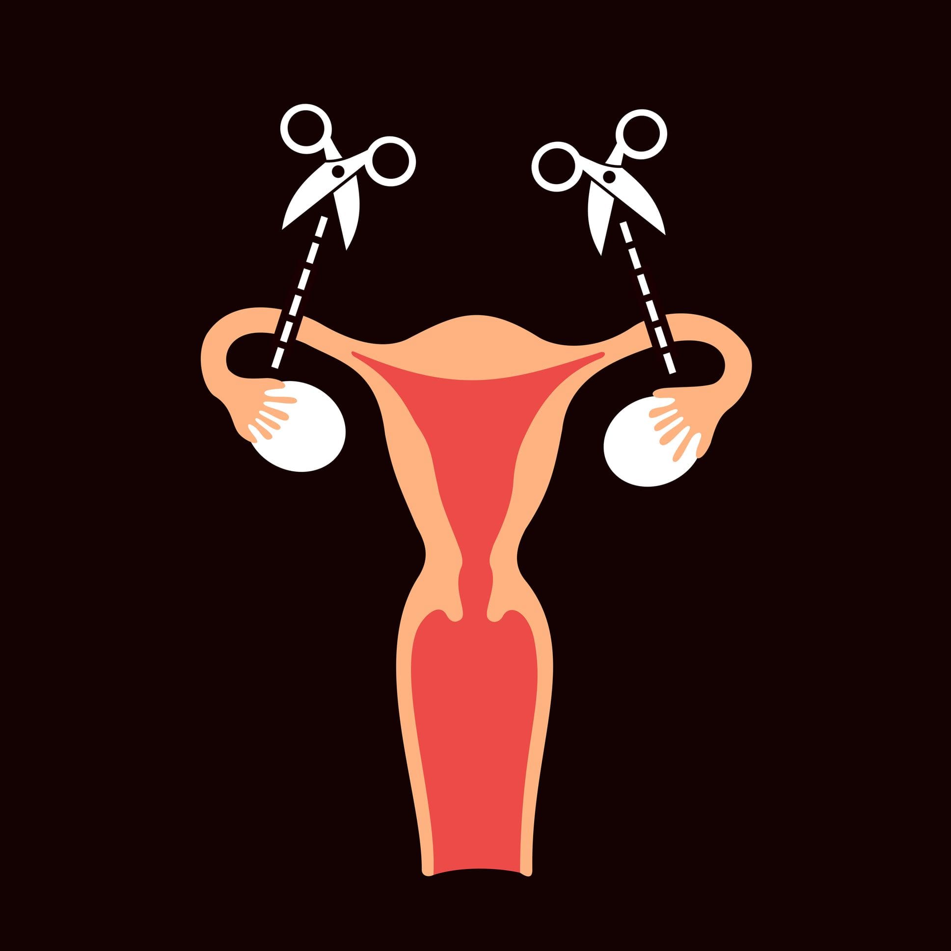 Contraception: female surgical sterilisation