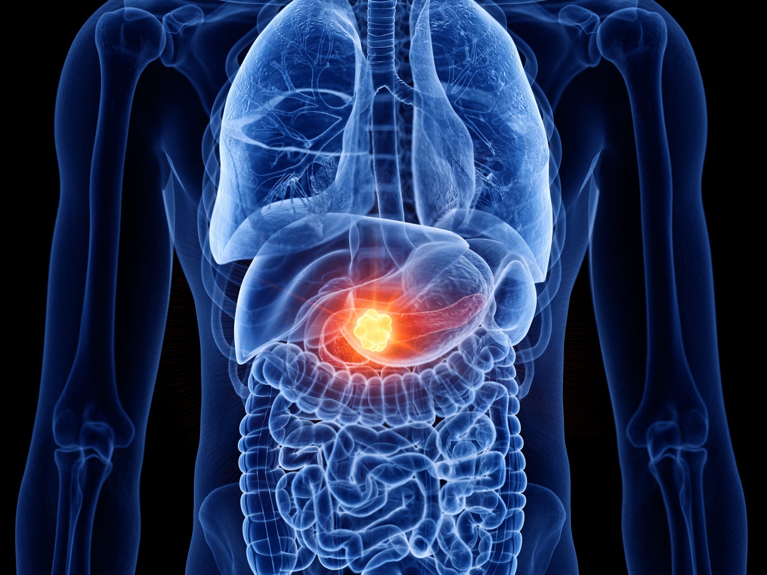 Quality care for pancreatic cancer