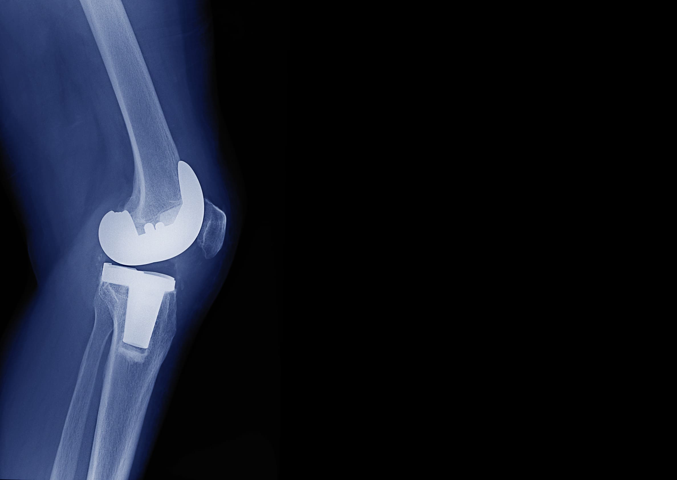 How long do hip and knee replacements last?