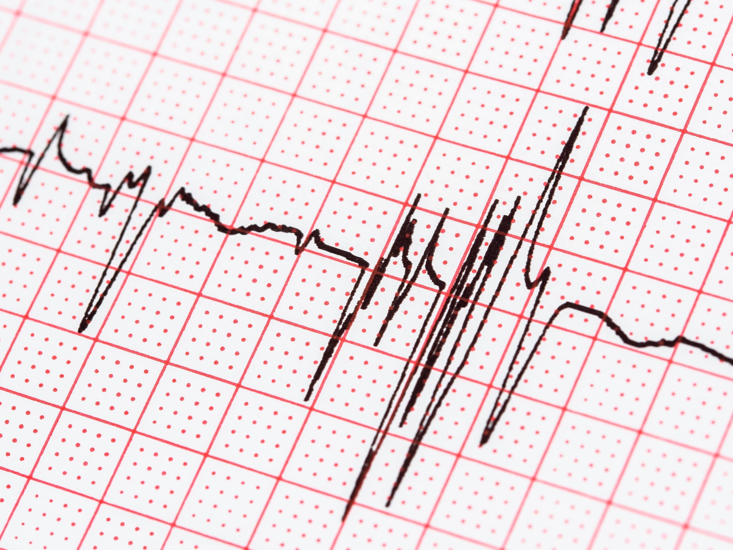 Atrial Fibrillation