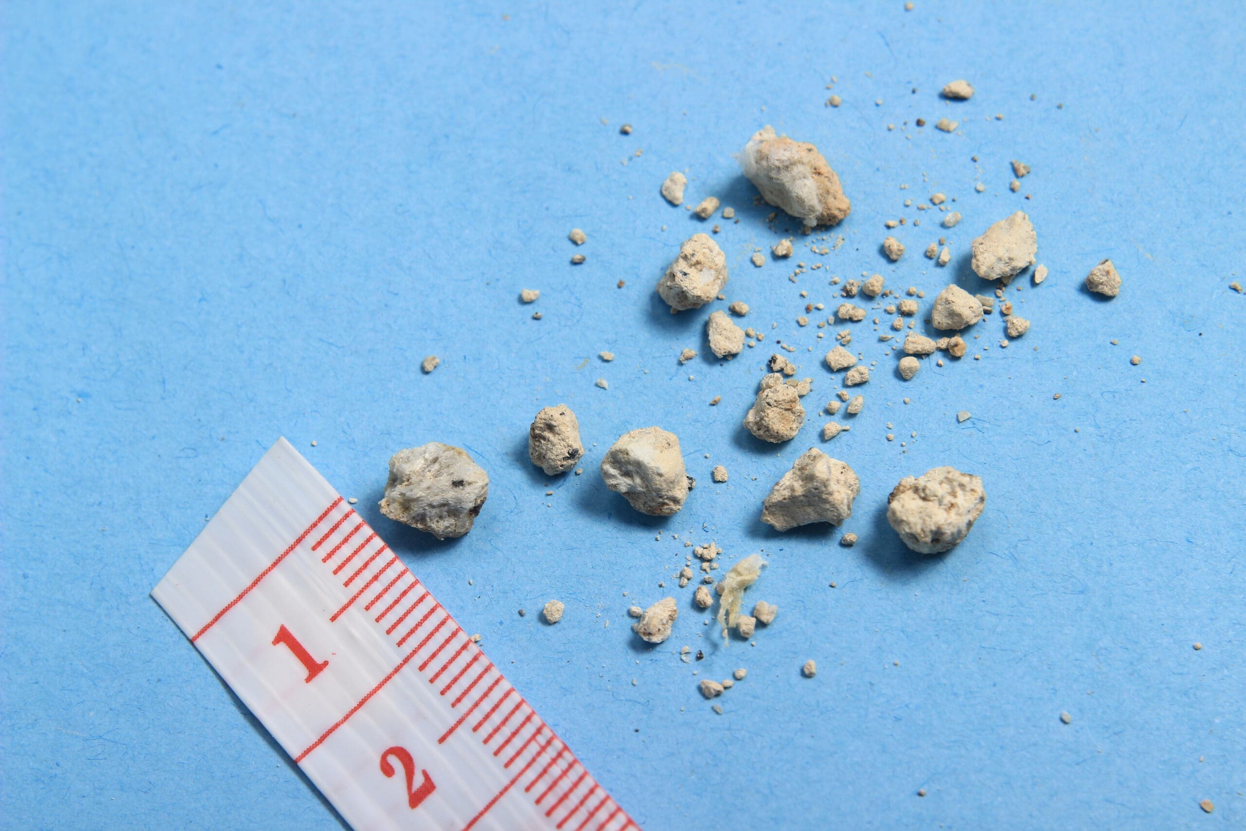 Kidney stones – symptoms, causes and treatment