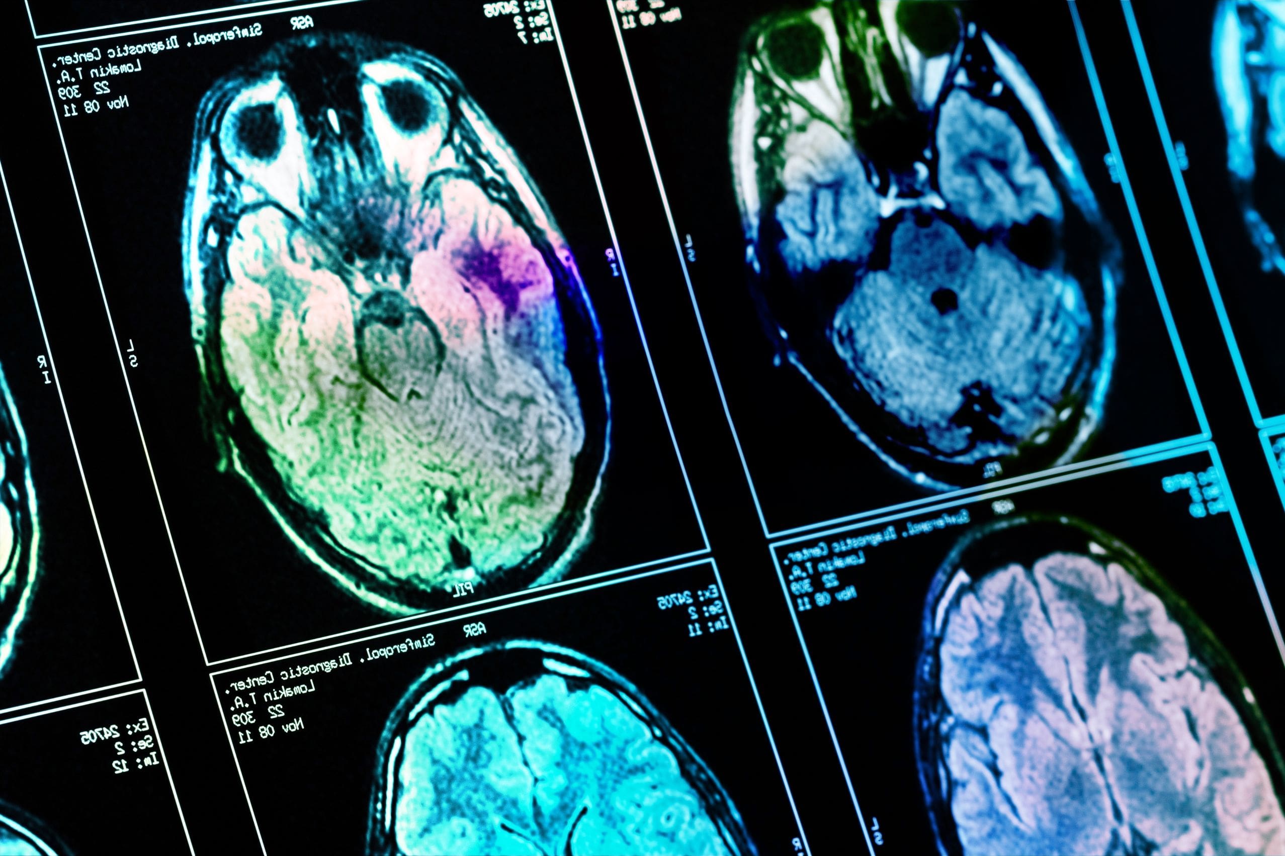 What causes brain cancer?