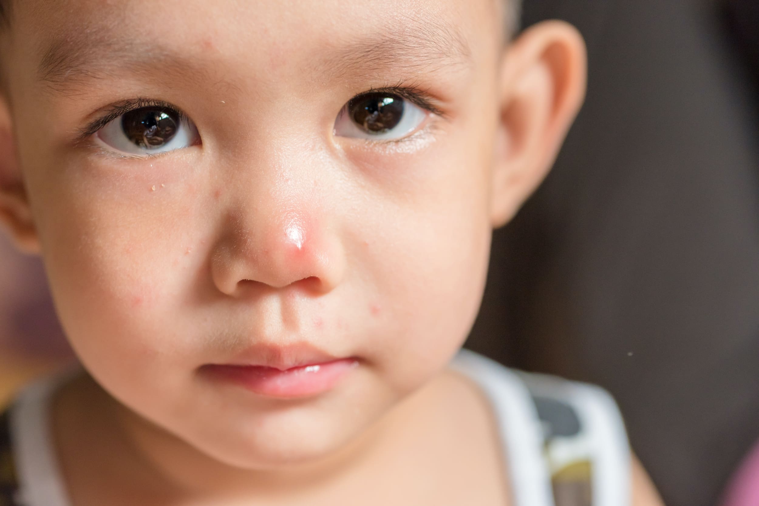What is hand, foot and mouth disease? Dr. Norman Swan