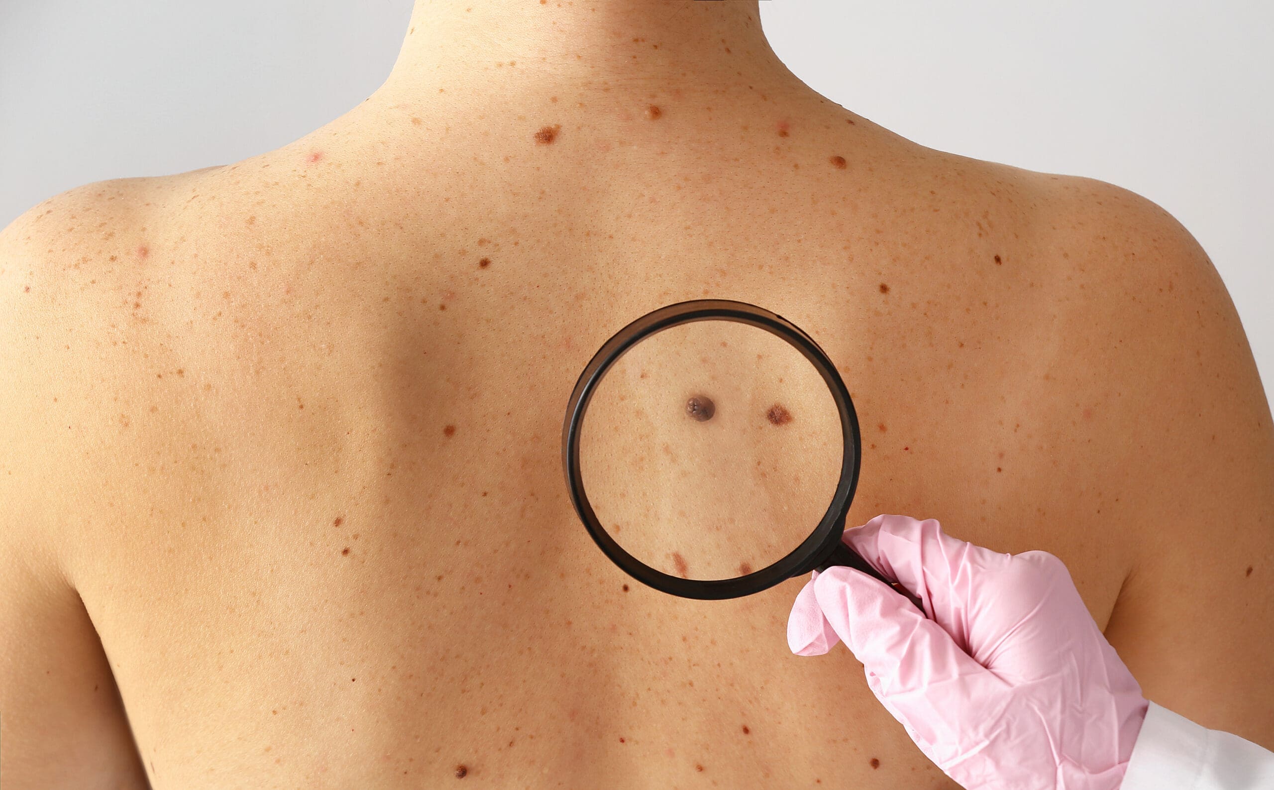 Melanoma Cases and Deaths Predicted to Rise in the Next Two Decades