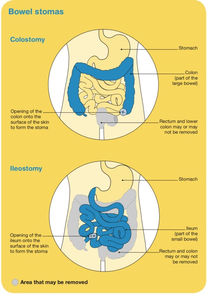 bowel cancer stomas