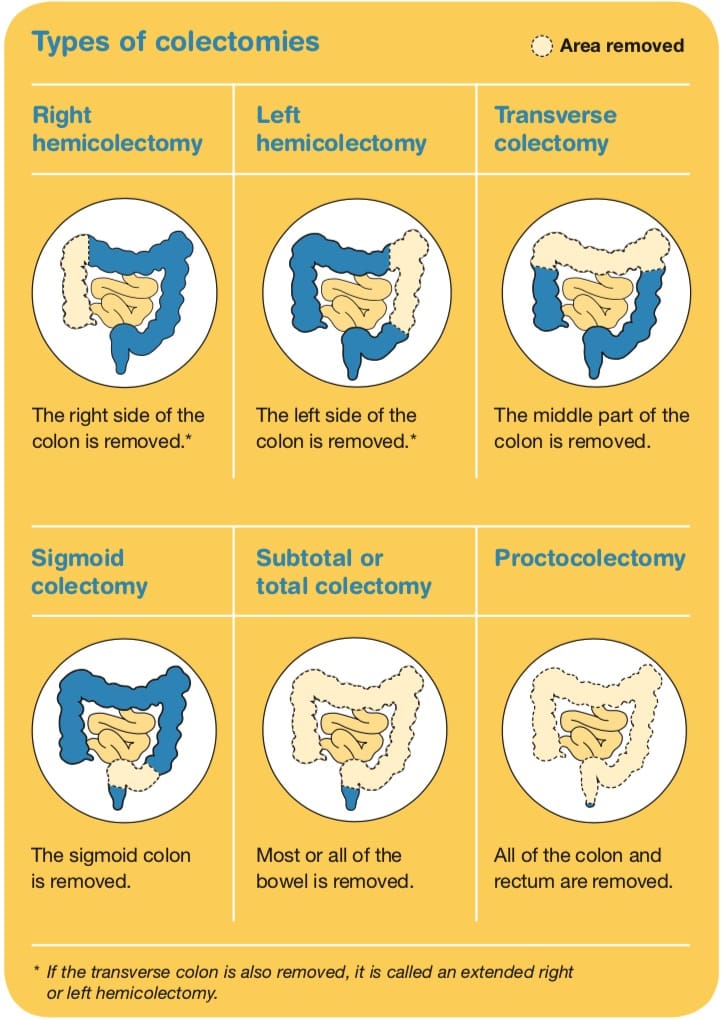 bowel cancer types of colectomies