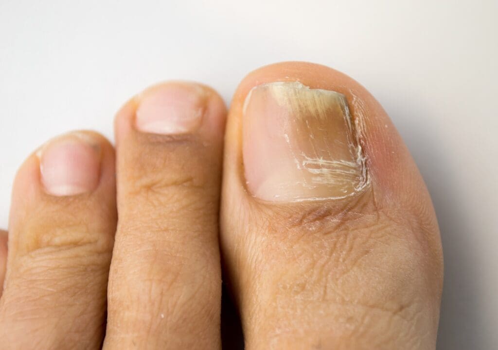 fungal infection of toenail