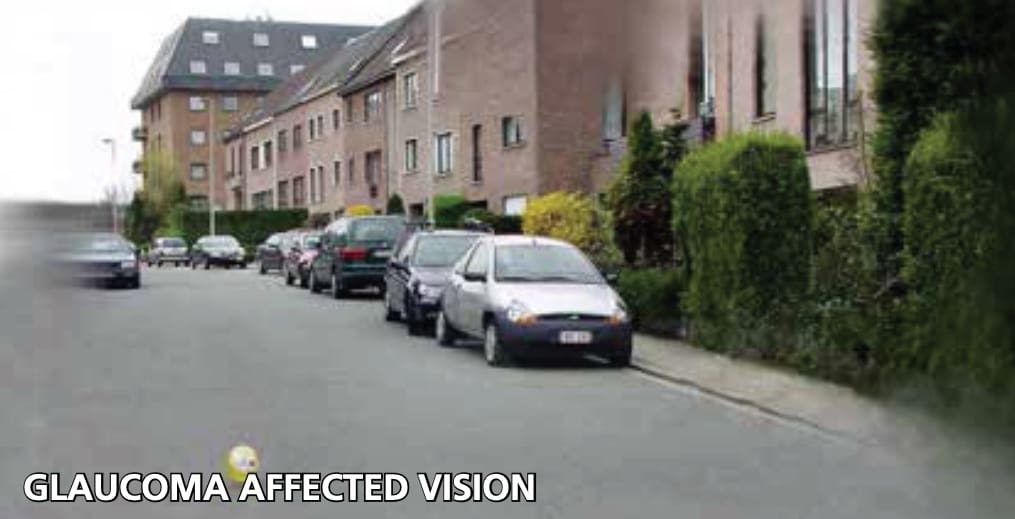 glaucoma affected vision