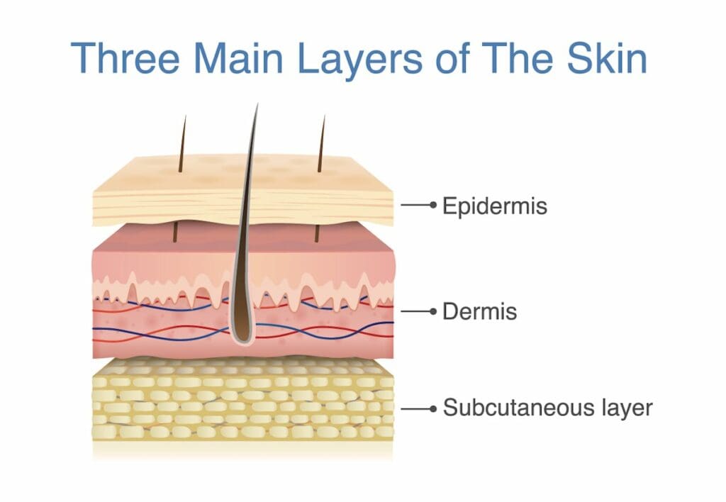cellulitis layers of skin