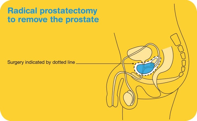 prostate cancer surgery