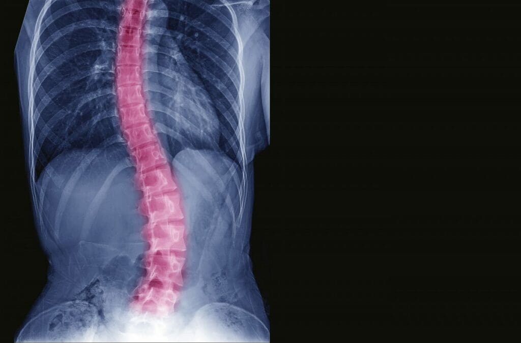X-ray of spine showing scoliosis