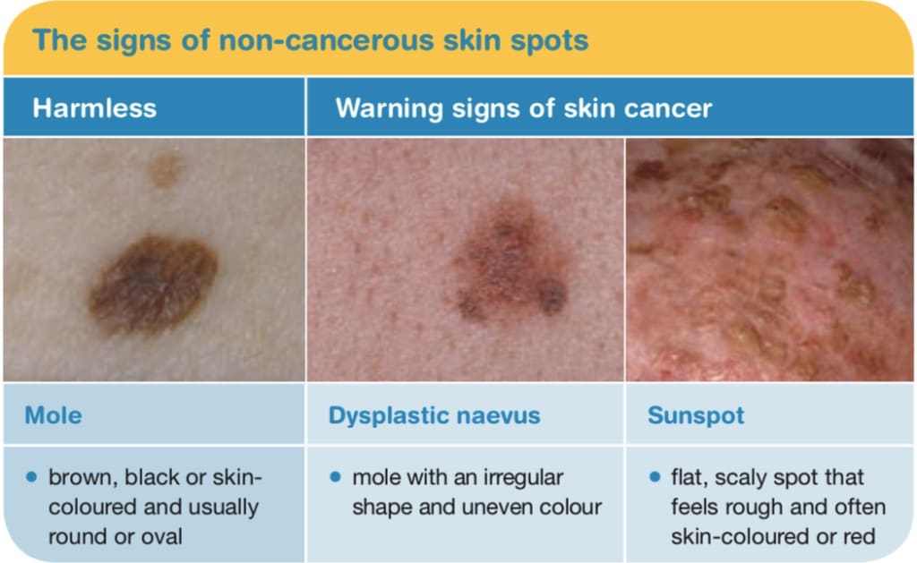 skin cancer signs non cancerous
