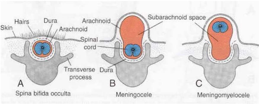 what is spina bifida occulta