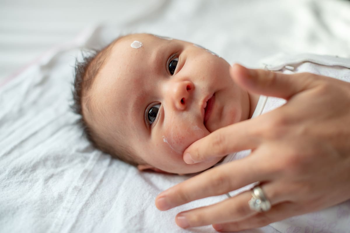 Eczema can present at anyone at any time, including in babies.